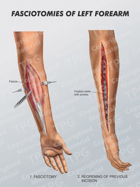 Fasciotomies Of Left Forearm Order