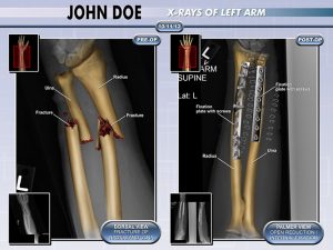 arm-fracture-x-ray-orif-pre-post-op