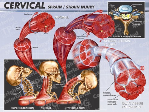 cervical-sprain-strain-injury-landscape