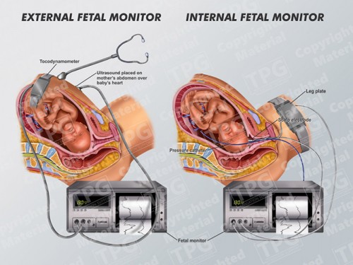 fetal-monitor-internal-external