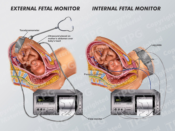 External Internal Fetal Monitor Order