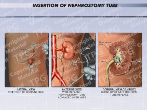 Insertion-Nephrostomy-Tube