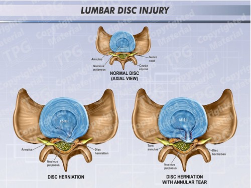 Lumbar-Disc-Injury-2