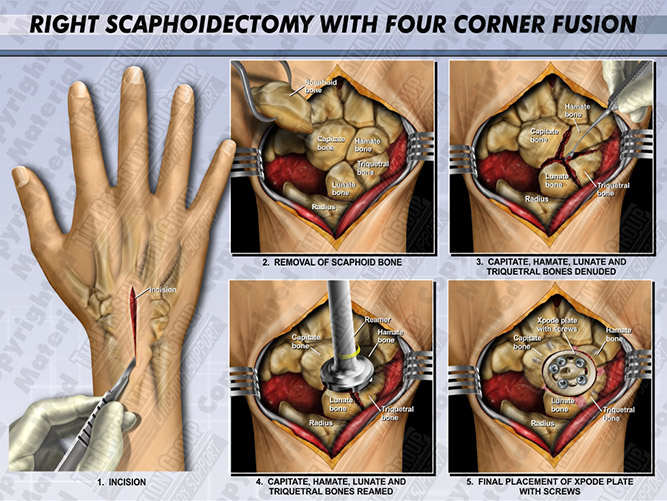 scaphoidectomy-fusion-right