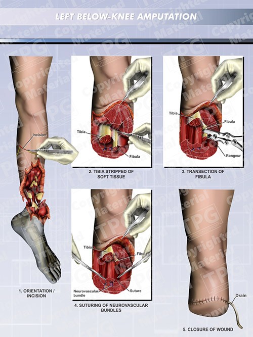 amputation-left-below-knee