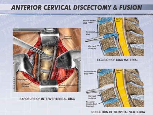 anterior-cervical-discectomy-fusion-2-one-level