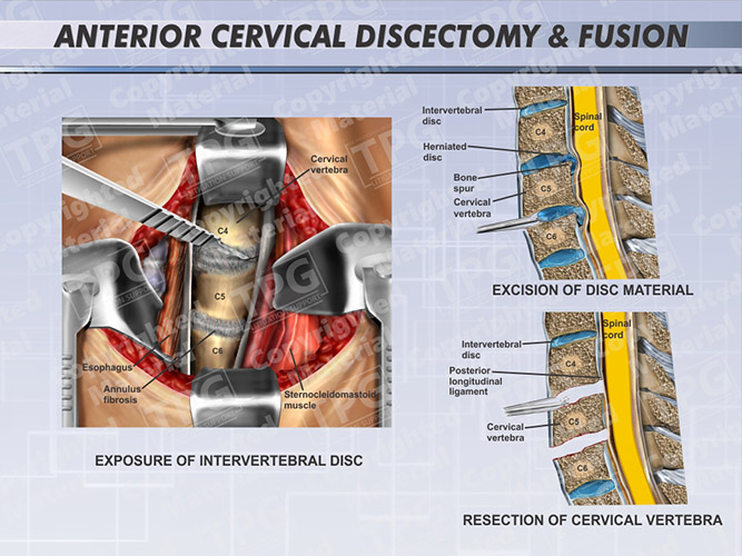 Anterior Cervical Discectomy Fusion Male One Level Order