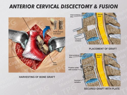 anterior-cervical-discectomy-fusion-3-one-level
