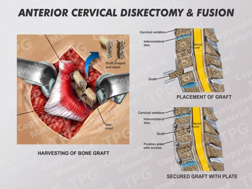 anterior-cervical-diskectomy-fusion-3-two-level