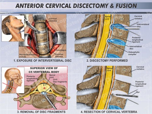 anterior-cervical-discectomy-fusion-female-aio