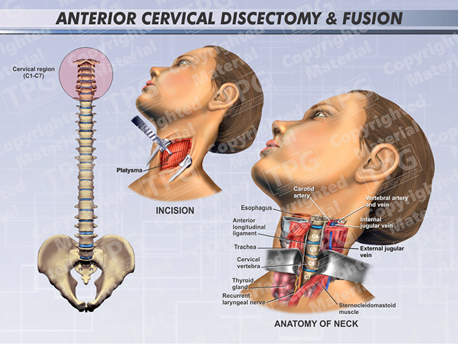 Anterior Cervical Discectomy And Fusion Female 2 Order