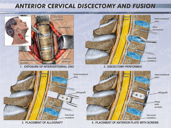 Anterior Cervical Discectomy And Fusion Two Level Order