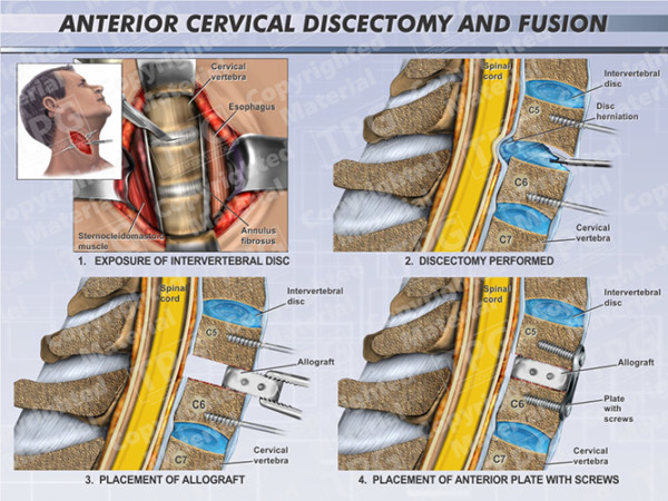 Anterior Cervical Discectomy & Fusion Two Level - Order