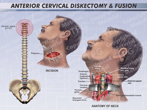 anterior-cervical-diskectomy-fusion-male