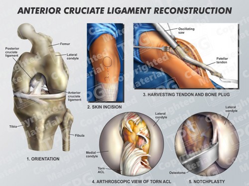 anterior-cruciate-ligament-reconstruction-1-of-2