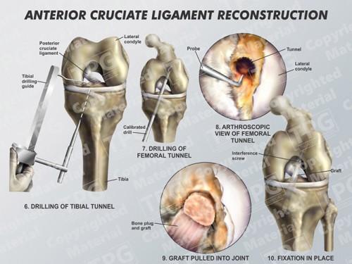 anterior-cruciate-ligament-reconstruction-2-of-2