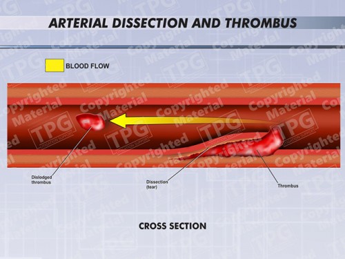 arterial-dissection-and-thrombus