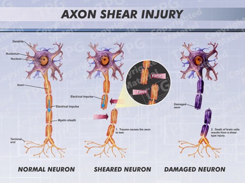 axon-shear-injury