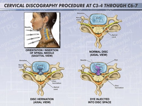 cervical-discography-procedure-at-c3-4-through-c6-7