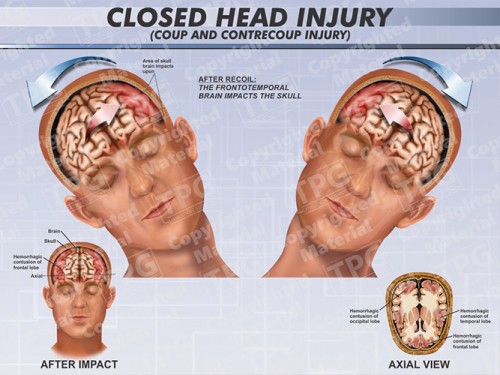 closed-head-injury