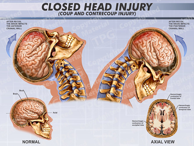 head injury video fractal