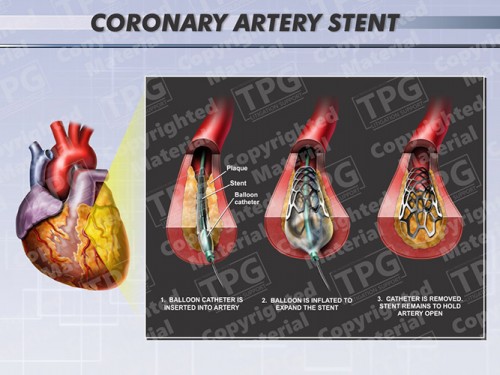 coronary-artery-stent