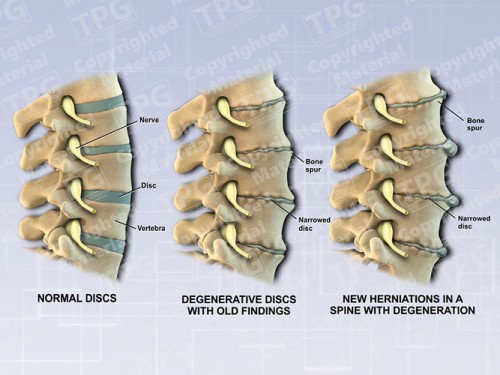 disc-herniations