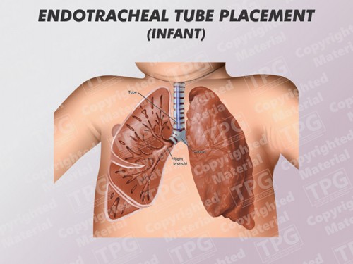 endotracheal-tube-placement-infant