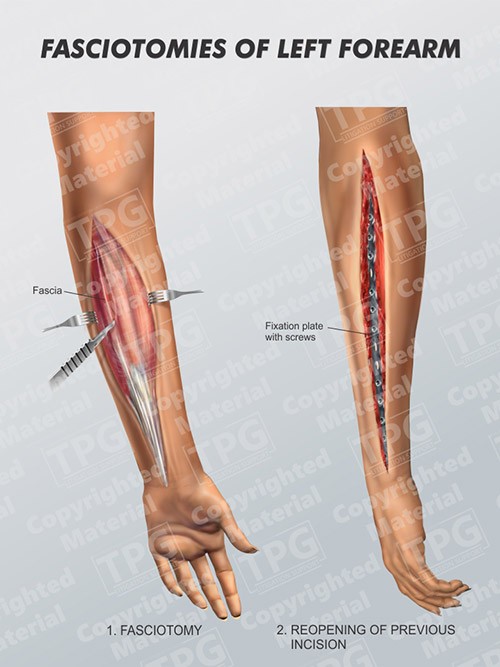 fasciotomies-of-left-forearm