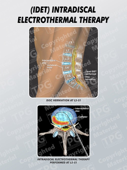 idet-intradiscal-electrothermal-therapy