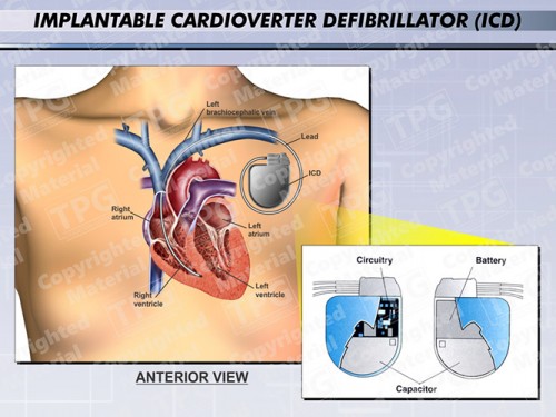 implantable-cardioverter-defibrillator-icd