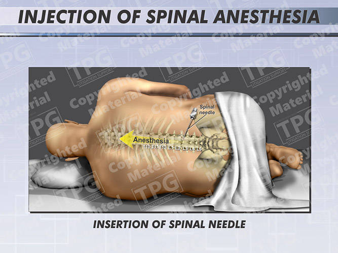 injection-of-spinal-anesthesia