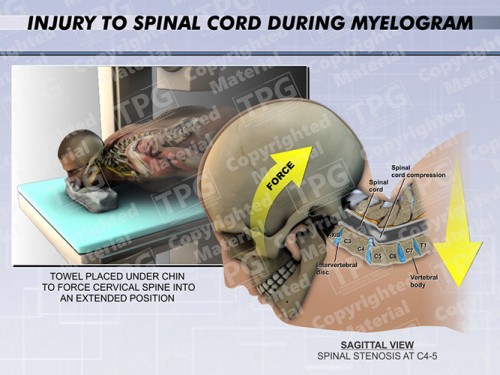 injury-to-spinal-cord-during-myelogram
