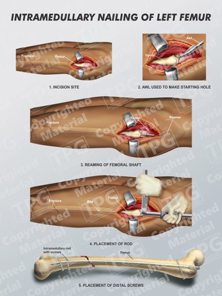 icd 10 code for aftercare orif left femur