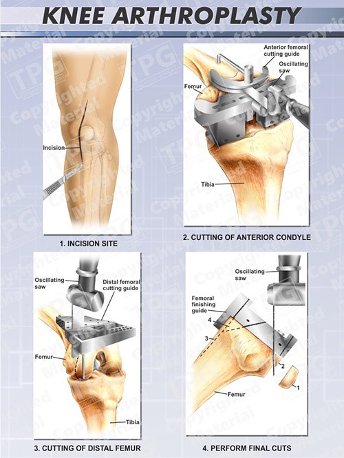 knee-arthroplasty-1-of-2