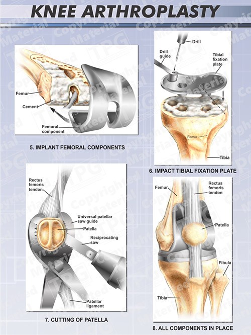 knee-arthroplasty-2-of-2