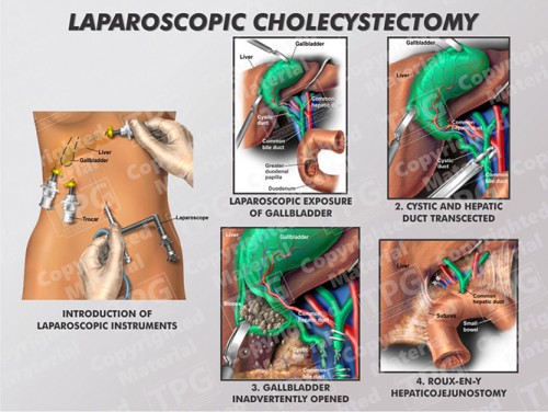 laparoscopic-cholecystectomy