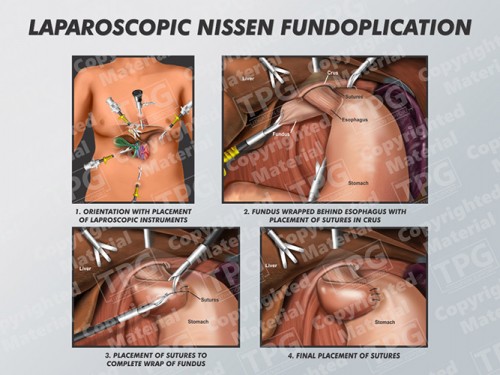 laparoscopic-nissen-fundoplication