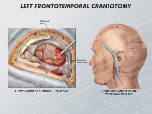 left-frontotemporal-craniotomy-1