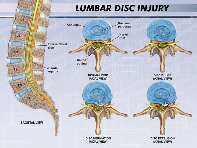 lumbar-disc-injury