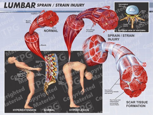 lumbar-sprain-strain-injury-landscape
