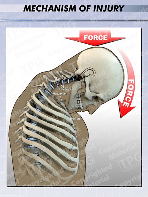 mechanism-of-neck-injury