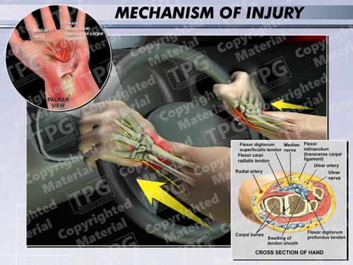 mechanism-of-wrist-injury