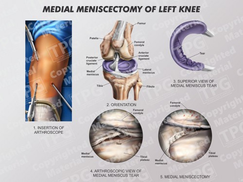 medial-meniscectomy-of-left-knee-landscape