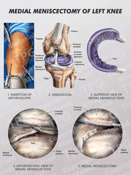 medial-meniscectomy-of-left-knee-portrait