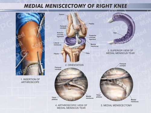 medial-meniscectomy-of-right-knee-landscape