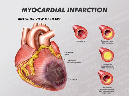 myocardial-infarction