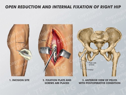 open-reduction-and-internal-fixation-right-hip