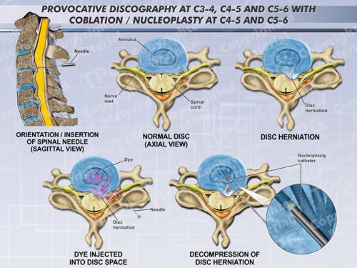 provocative-discography-at-c3-4-c4-5-c5-6-with-coblation-nucleoplasty-at-c4-5-c5-6
