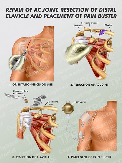 repair-of-ac-joint-resection-of-distal-clavicle-and-placement-of-pain-buster